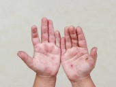 Confirman brote de virus Coxsackie en escuelas de Tlaxcala