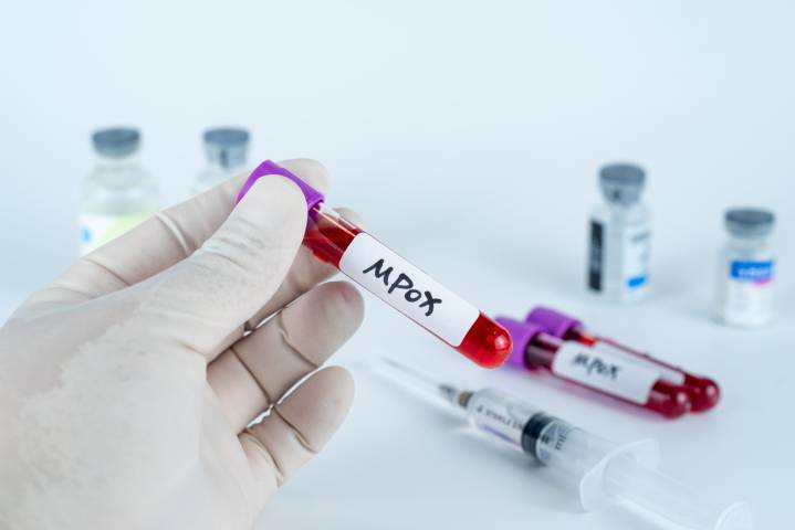 Another Case of Severe Mpox Strain Appears in LACo