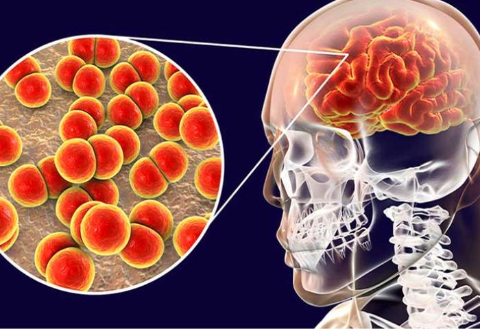 Más de 500 casos de meningitis en Colombia durante 2025: menores de cinco años, los más afectados