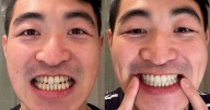 The dentist-approved teeth whitening solution with 70% off away from Prime Day