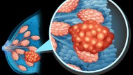 Localizan el ganglio clave del cáncer de mama sin cirugía agresiva