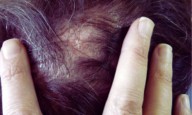 Intralesional Triamcinolone Outperforms Methotrexate in Alopecia Areata, suggests research