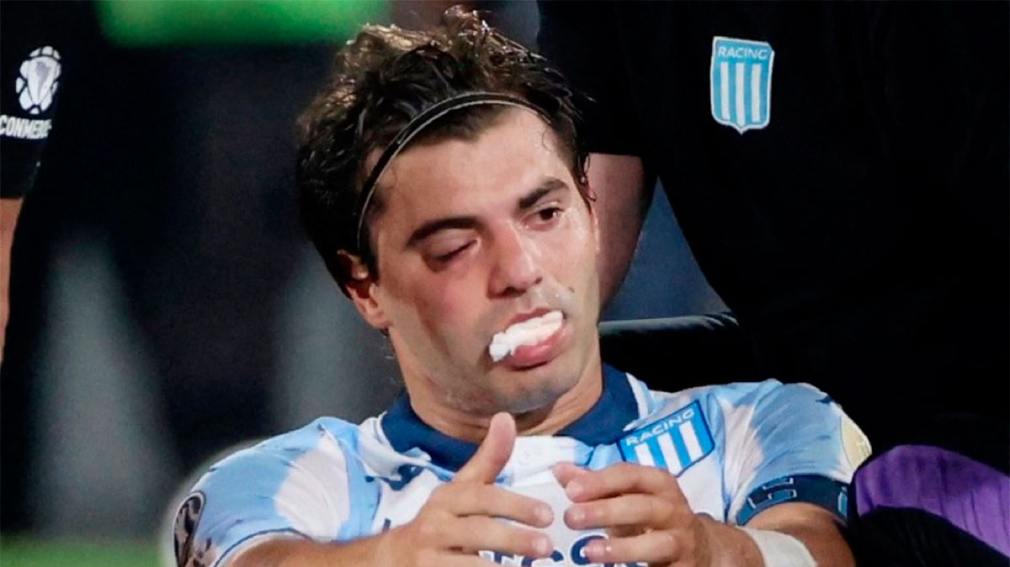 Santiago Sosa fue operado por la fractura ante Flamengo: cuánto tiempo lo perderá Racing