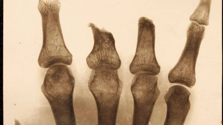 Are infections leading to preventable amputations in India? Doctors call for urgent reforms in wound care