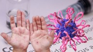 Virus Coxsackie contagió a 17 niños en escuela de Puebla; ¿cuál es su estado de salud?