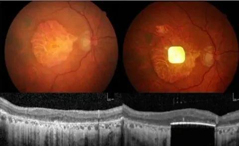 New retinal implant restores vision in patients with irreversible blindness