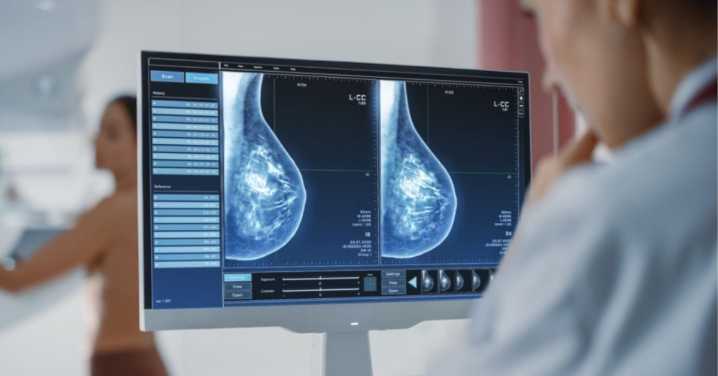 Cáncer de mama en Perú: Detección temprana y los tratamientos personalizados elevan la supervivencia hasta el 90%