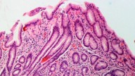 Helicobacter pylori: así son los síntomas de la infección que afecta a la mitad de la población