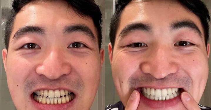 Prime Day shoppers snap up 'better than Amazon' £9 deal on teeth whitening solution