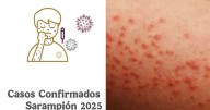 Sarampión en México: más de 5 mil contagios y 23 muertes; lista de estados en alerta