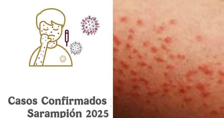 Sarampión en México: más de 5 mil contagios y 23 muertes; lista de estados en alerta