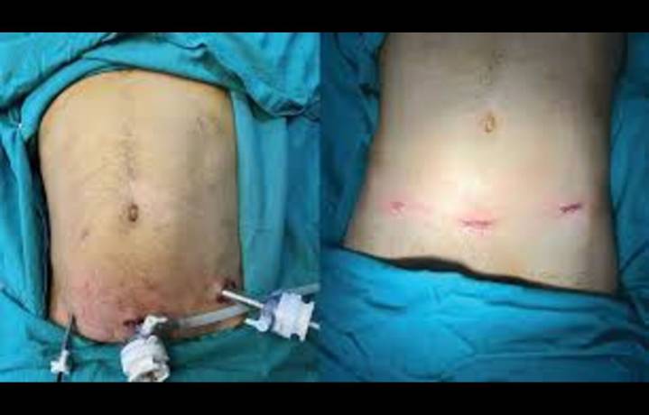 Routine Abdominal Drain Not Recommended After Laparoscopic Appendectomy for Perforated Appendicitis:...