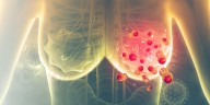 ¿Por qué ocurren las metástasis del cáncer de mama?