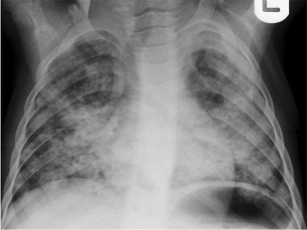 Routine chest X-rays miss 40% of asymptomatic TB cases: Lancet study