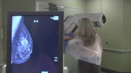 Woman's clean mammogram nearly missed second breast cancer diagnosis