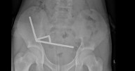 Teen swallows 100 magnets off Temu - then is left in agony needing major surgery
