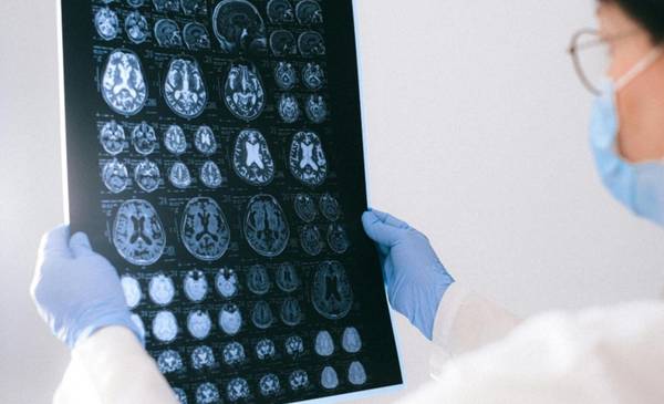 Hallazgo en epilepsia: siete metabolitos que predicen una crisis