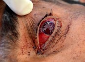 14 Children Blinded, 120 Injured After Playing with Carbide Guns on Diwali Eve