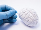 Ask the Experts: Deep brain stimulation offers options for patients and neurosurgeons