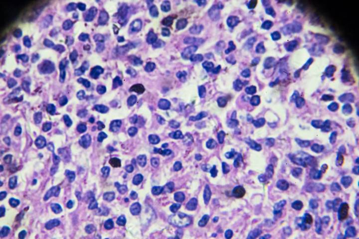 Epigenetic–Immunotherapy Combo Reverses Resistance in Aggressive NK/T