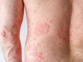 Psoriasis, más allá de la piel: cómo evitar el efecto dominó, y la diferencia clave que puede cambiar el pronóstico