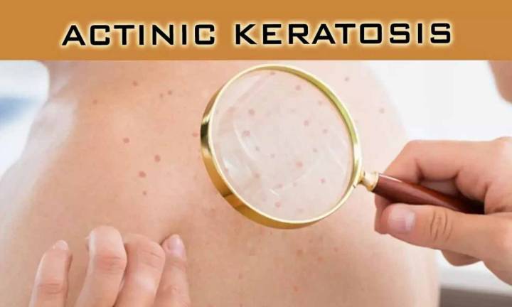 Bimiralisib Gel Shows Strong Efficacy for Early-Stage Actinic Keratosis in Phase 2 trial