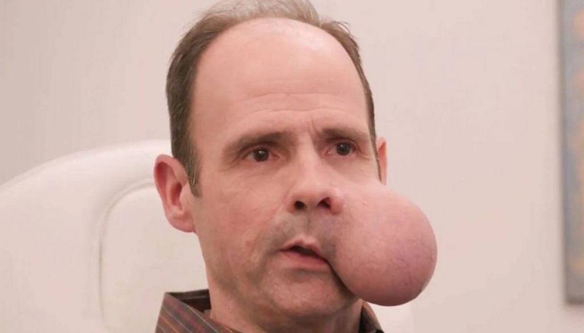 El caso del hombre que tiene un tumor de 2 kilos en su rostro: "Sentencia de muerte"