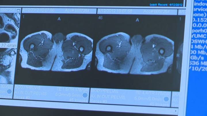 Doctors and patients urge lawmakers to remove barriers to early prostate cancer