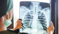 Canarias registra 1.500 casos de cáncer de pulmón al año, el 80% con metástasis