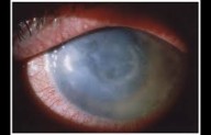 Early Detection and Treatment Key in Managing Acanthamoeba Keratitis, reveals research