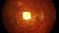 Revolutionary Prosthetic Eye Chip Restores Sight in Medical First