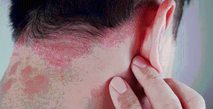 Día Mundial de la Psoriasis: la intervención temprana puede cambiar el curso de esta enfermedad crónica