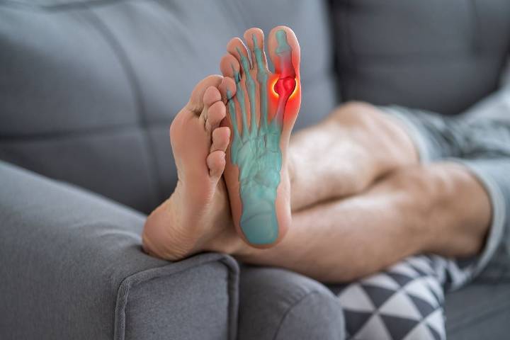 Gene Test Can Predict Risk For Gout Medicine Side Effects