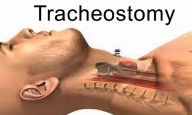 Petroleum Jelly Outperforms Saline in Preventing Tracheostomy Pressure Injuries: Study