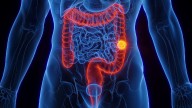 Bleeding Tied To Colon Cancer Risk Among Young Adults