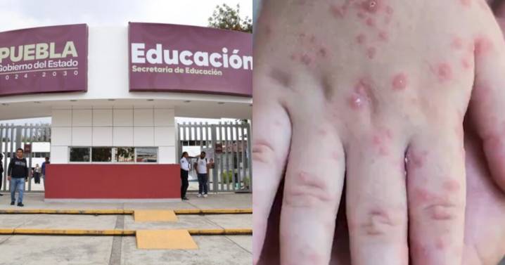 Más de 400 alumnos contagiados del virus Coxsackie en Puebla; suspenden clases en 77 escuelas