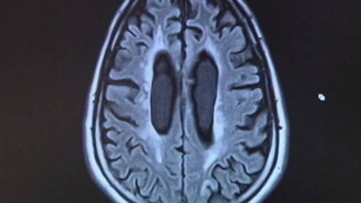 Proposition 14 could create new dementia research institute in Texas
