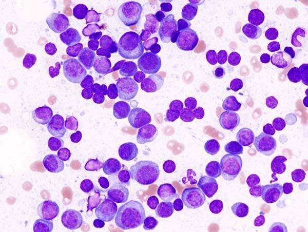 New Immunotherapy Treatments For Myeloma Show Positive Results