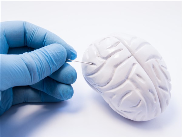 Ask the Experts: Deep brain stimulation offers options for patients and neurosurgeons