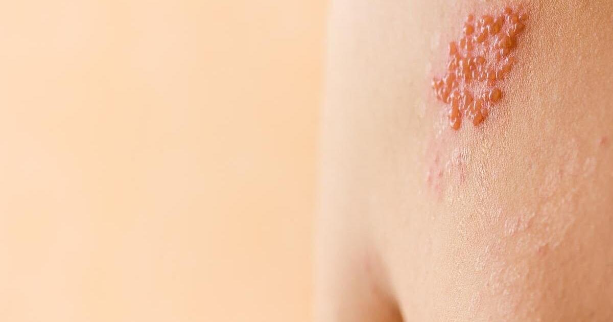 Shingles Vax Protects Against Heart Disease, Dementia, Death