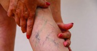 Mooresville Vein Clinic offers free consultations for chronic leg pain and swelling