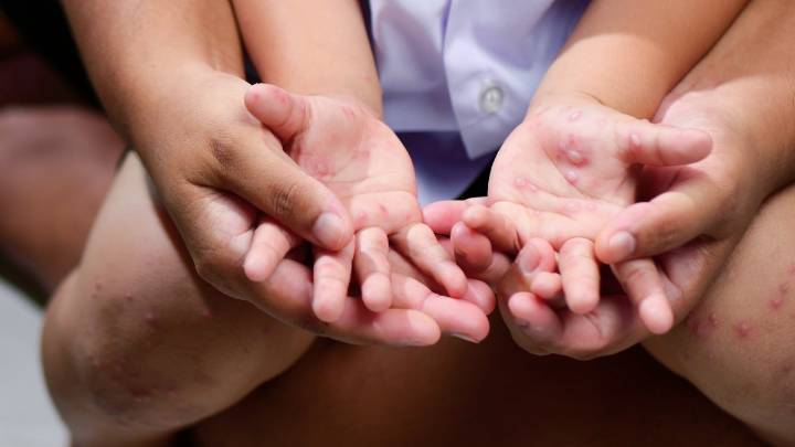 Prince George’s County Public Schools report hand, foot and mouth disease