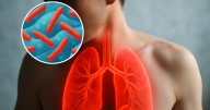 ¿Qué es la tuberculosis y como puedo identificarla?