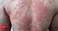 Obesity can damage your skin: Why dark patches, infections, and psoriasis are warning signs
