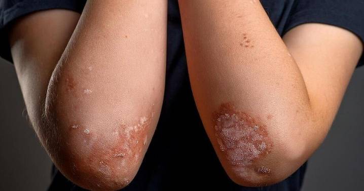 FDA Approves Tremfya for Pediatric Plaque Psoriasis, Active Psoriatic Arthritis