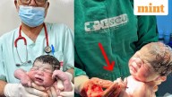 Brazilian baby holds contraceptive coil that was meant to prevent his birth