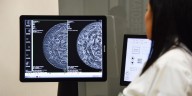 Así es como el IMSS recomienda hacer la autoexploración para detectar a tiempo el cáncer de mama