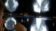 Early mammograms enhance breast cancer survival rates