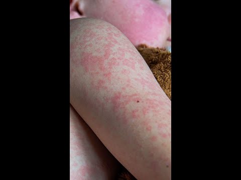South Carolina measles outbreak caused by low vaccination rates, doctors say