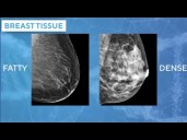 Doctors using AI mammogram readings to predict breast cancer risk